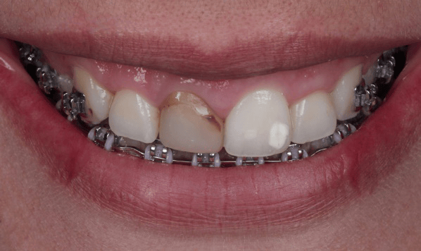 Esthetic Restorations in Severely Darkened Anterior Teeth using Dental Post in the Root Canal