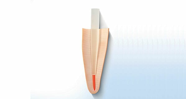 Anatomization of dental post: The best choice for canals that are wide or have a differentiated anatomy.