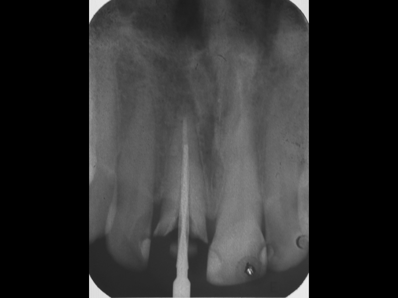 Depth of the root canal